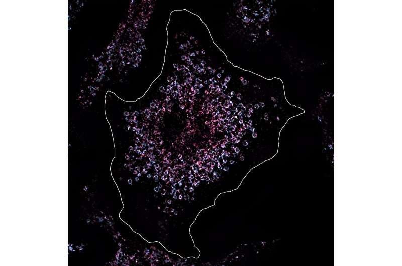 Researchers trace a form of lupus back to a single mutation